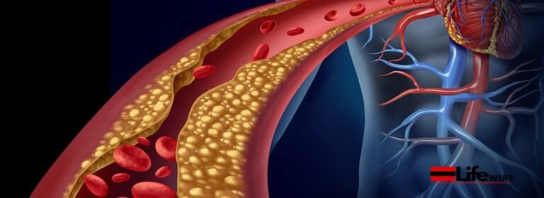 Understanding Hypercholesterolemia: Symptoms and Treatment